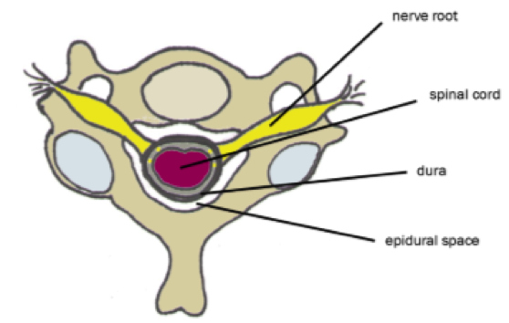 Epidural For Pain Relief in Labor: Benefits and Risks 1