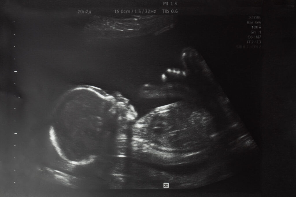 20-Week-Ultrasound 